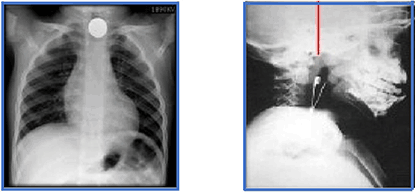 Common foreign body ingestions in children