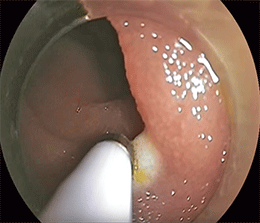 Electrosurgery coagulation wires.