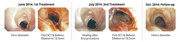 Concentric Tracheal Stenosis Case Images